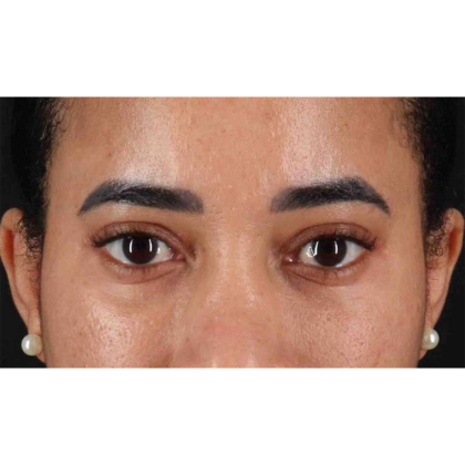 Blepharoplasty (Eyelid Surgery) Before & After Patient #10793