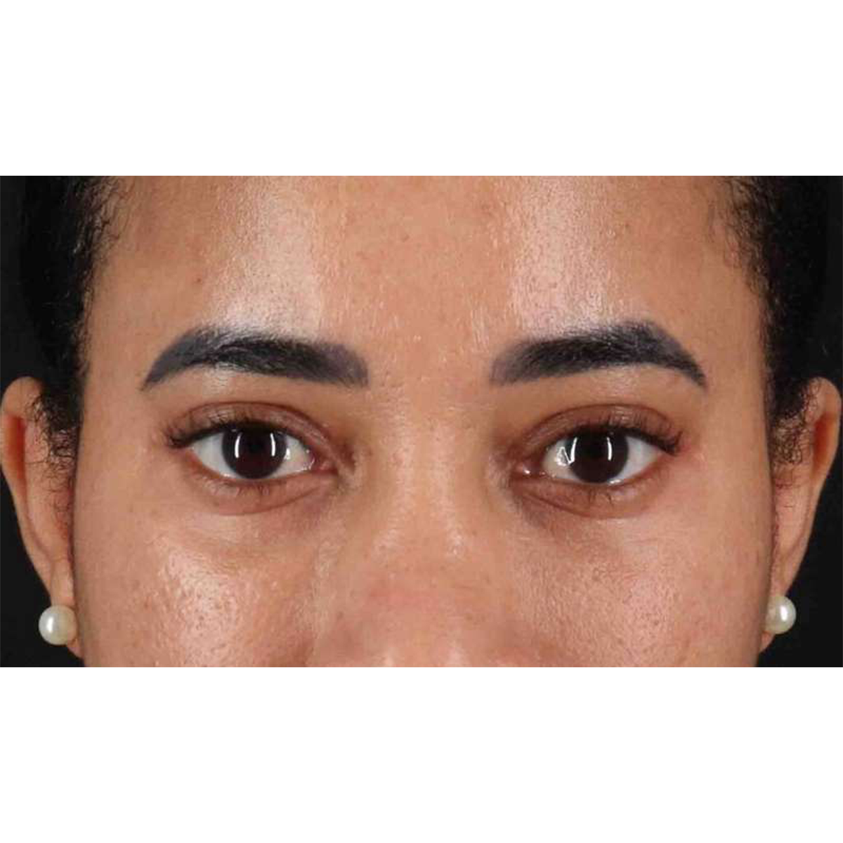 Blepharoplasty (Eyelid Surgery) Before & After Patient #10793