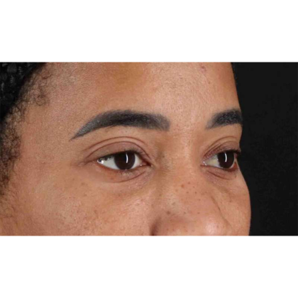 Blepharoplasty (Eyelid Surgery) Before & After Patient #10793
