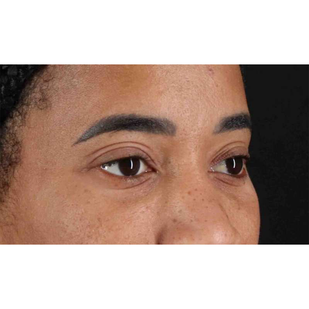 Blepharoplasty (Eyelid Surgery) Before & After Patient #10793