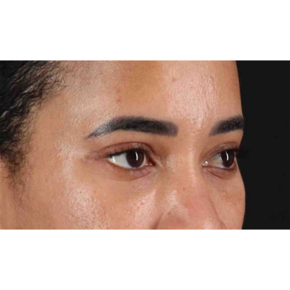 Blepharoplasty (Eyelid Surgery) Before & After Patient #10793