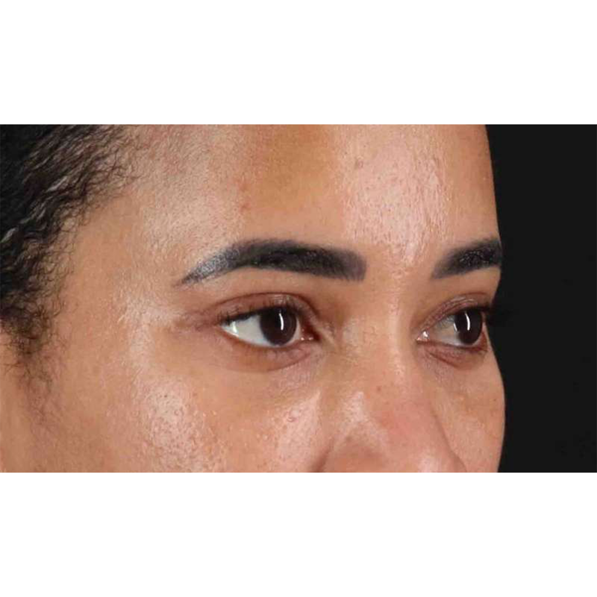 Blepharoplasty (Eyelid Surgery) Before & After Patient #10793