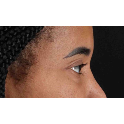 Blepharoplasty (Eyelid Surgery) Before & After Patient #10793