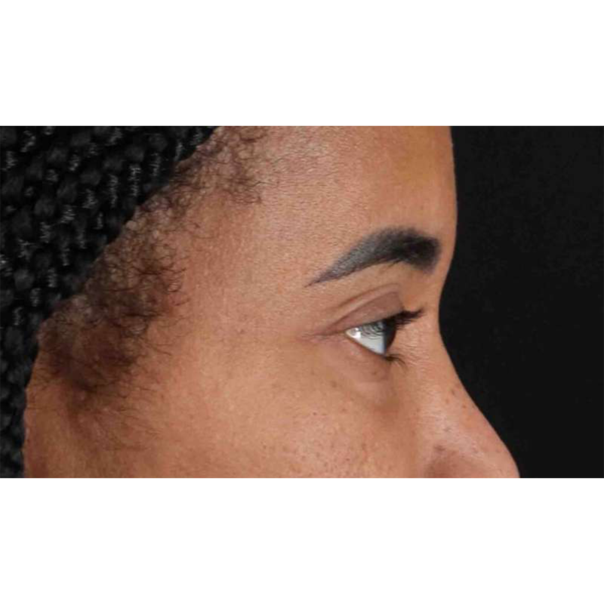 Blepharoplasty (Eyelid Surgery) Before & After Patient #10793