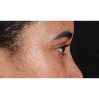 Blepharoplasty (Eyelid Surgery) Before & After Patient #10793