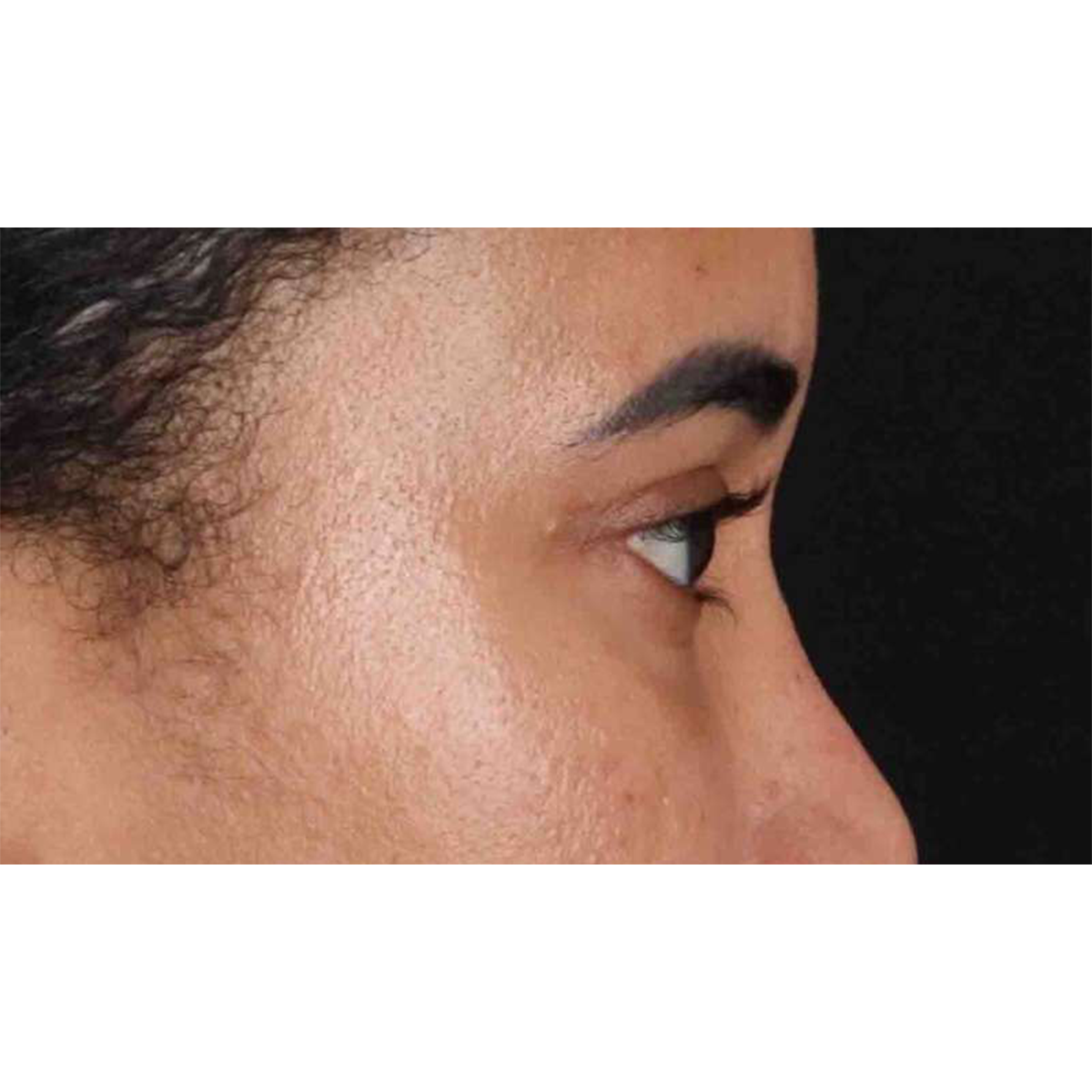 Blepharoplasty (Eyelid Surgery) Before & After Patient #10793