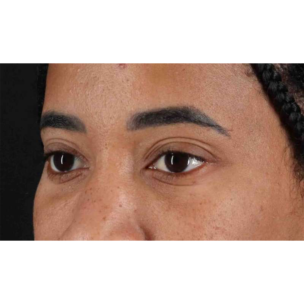 Blepharoplasty (Eyelid Surgery) Before & After Patient #10793