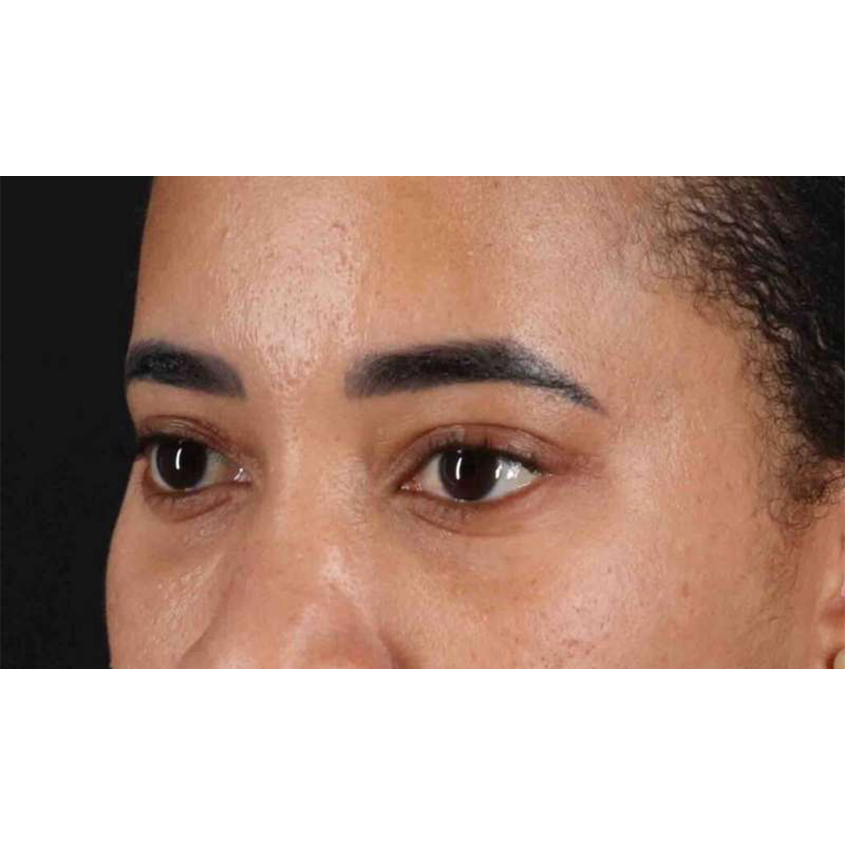 Blepharoplasty (Eyelid Surgery) Before & After Patient #10793