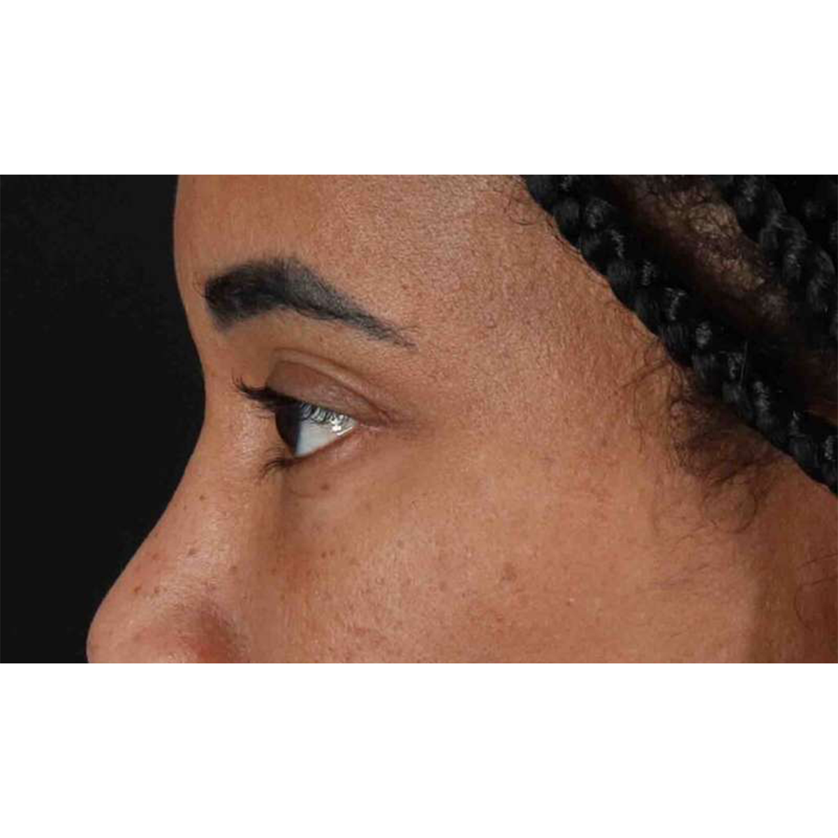 Blepharoplasty (Eyelid Surgery) Before & After Patient #10793