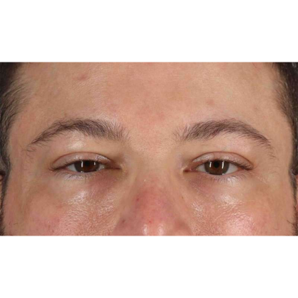 Blepharoplasty (Eyelid Surgery) Before & After Patient #10628