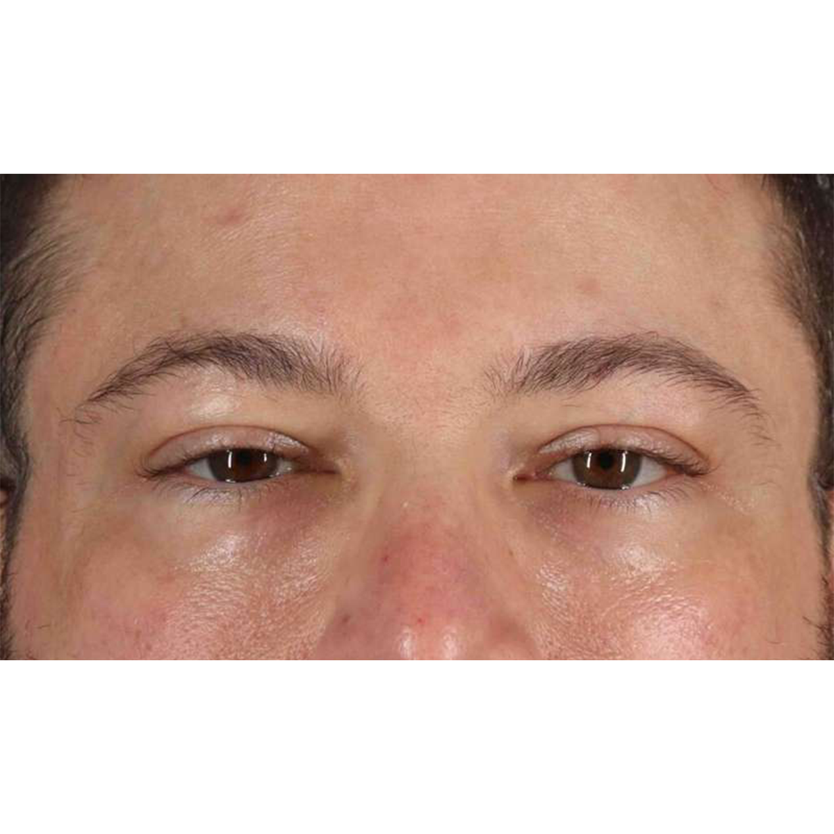 Blepharoplasty (Eyelid Surgery) Before & After Patient #10628