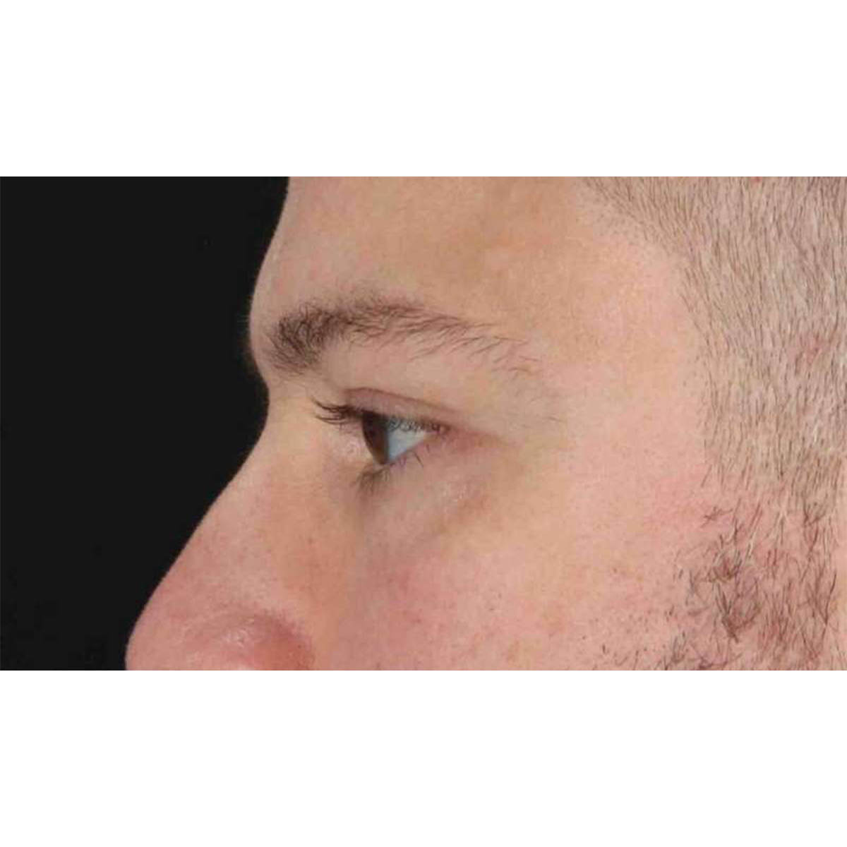 Blepharoplasty (Eyelid Surgery) Before & After Patient #10628