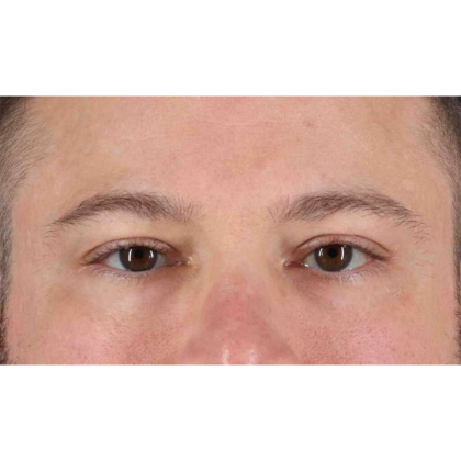 Blepharoplasty (Eyelid Surgery) Before & After Patient #10628