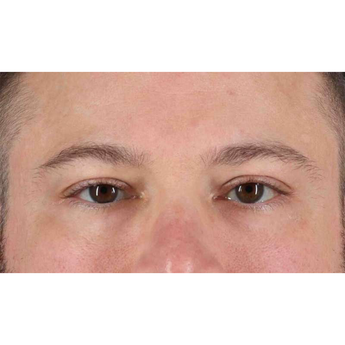 Blepharoplasty (Eyelid Surgery) Before & After Patient #10628