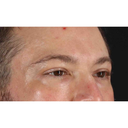 Blepharoplasty (Eyelid Surgery) Before & After Patient #10628