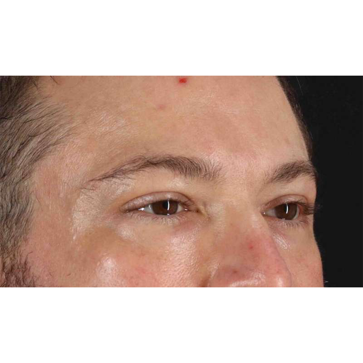 Blepharoplasty (Eyelid Surgery) Before & After Patient #10628