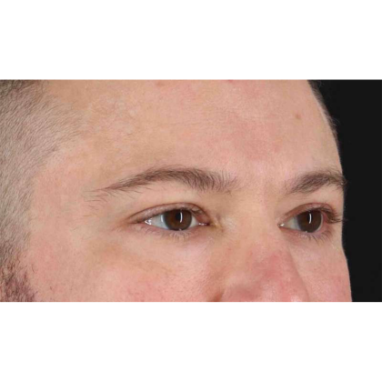 Blepharoplasty (Eyelid Surgery) Before & After Patient #10628