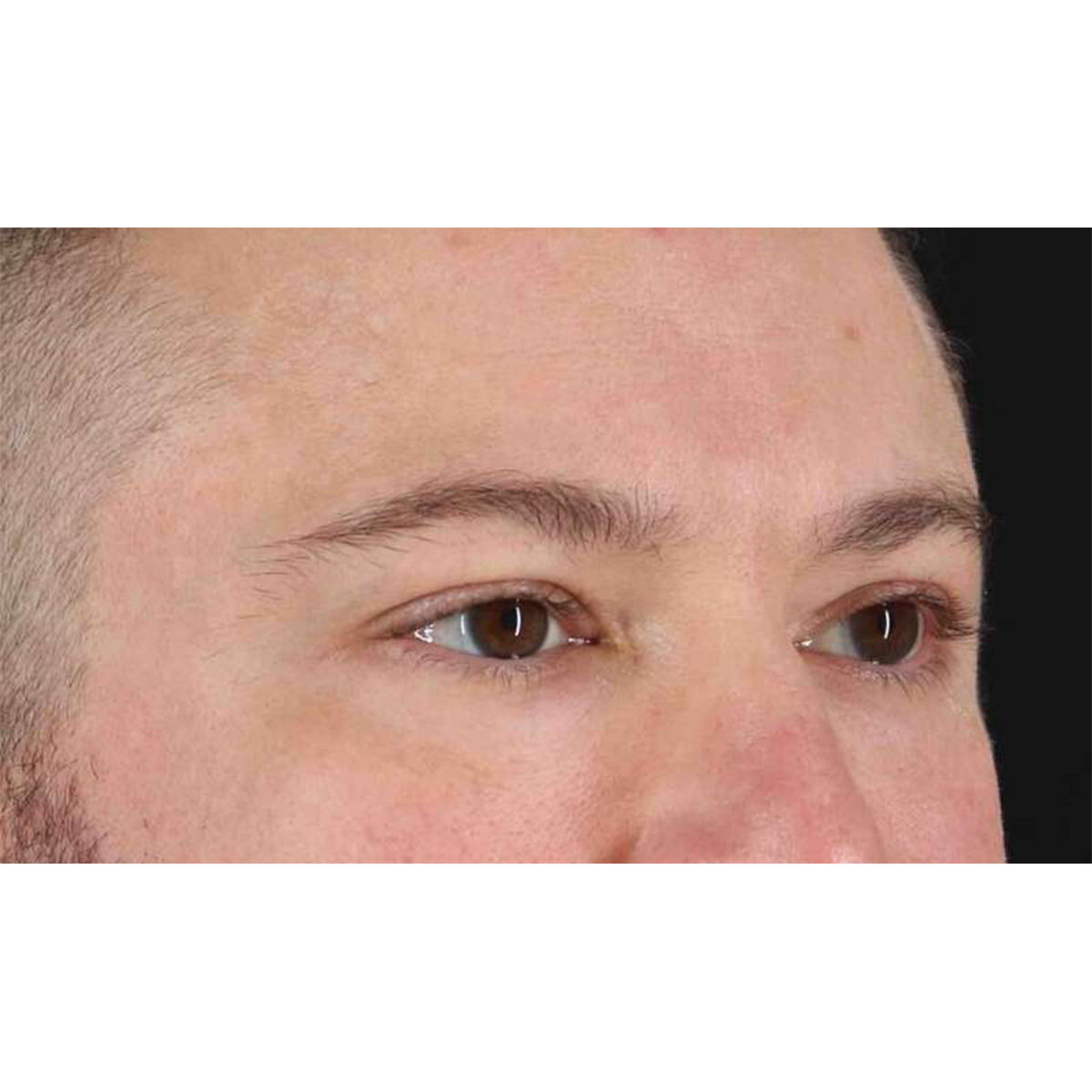 Blepharoplasty (Eyelid Surgery) Before & After Patient #10628