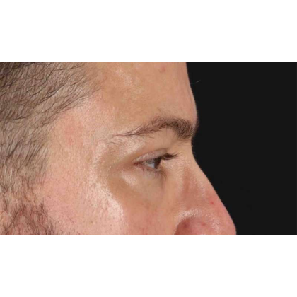 Blepharoplasty (Eyelid Surgery) Before & After Patient #10628