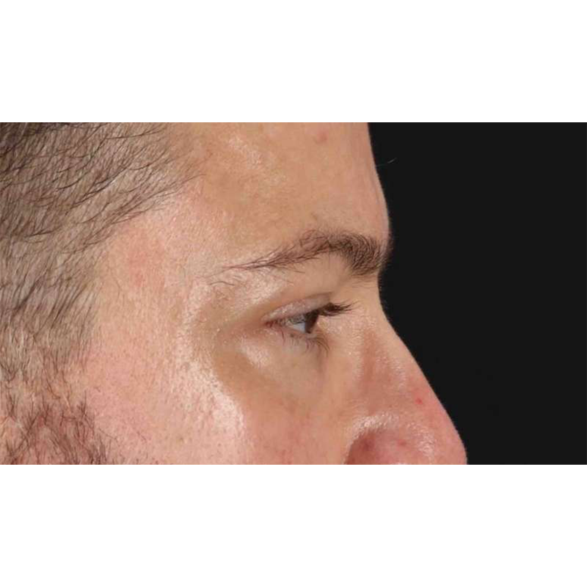 Blepharoplasty (Eyelid Surgery) Before & After Patient #10628
