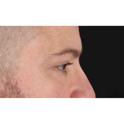 Blepharoplasty (Eyelid Surgery) Before & After Patient #10628