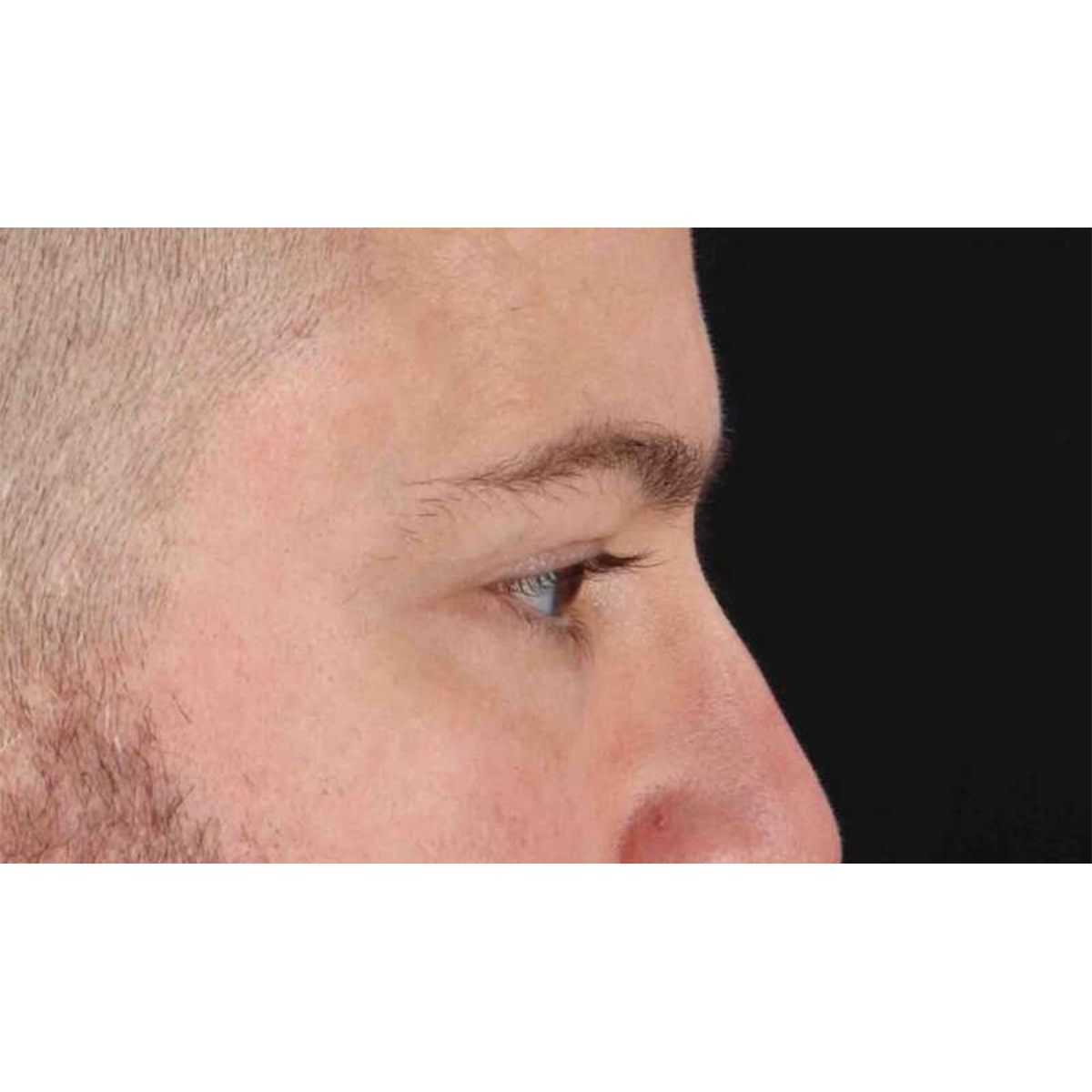 Blepharoplasty (Eyelid Surgery) Before & After Patient #10628
