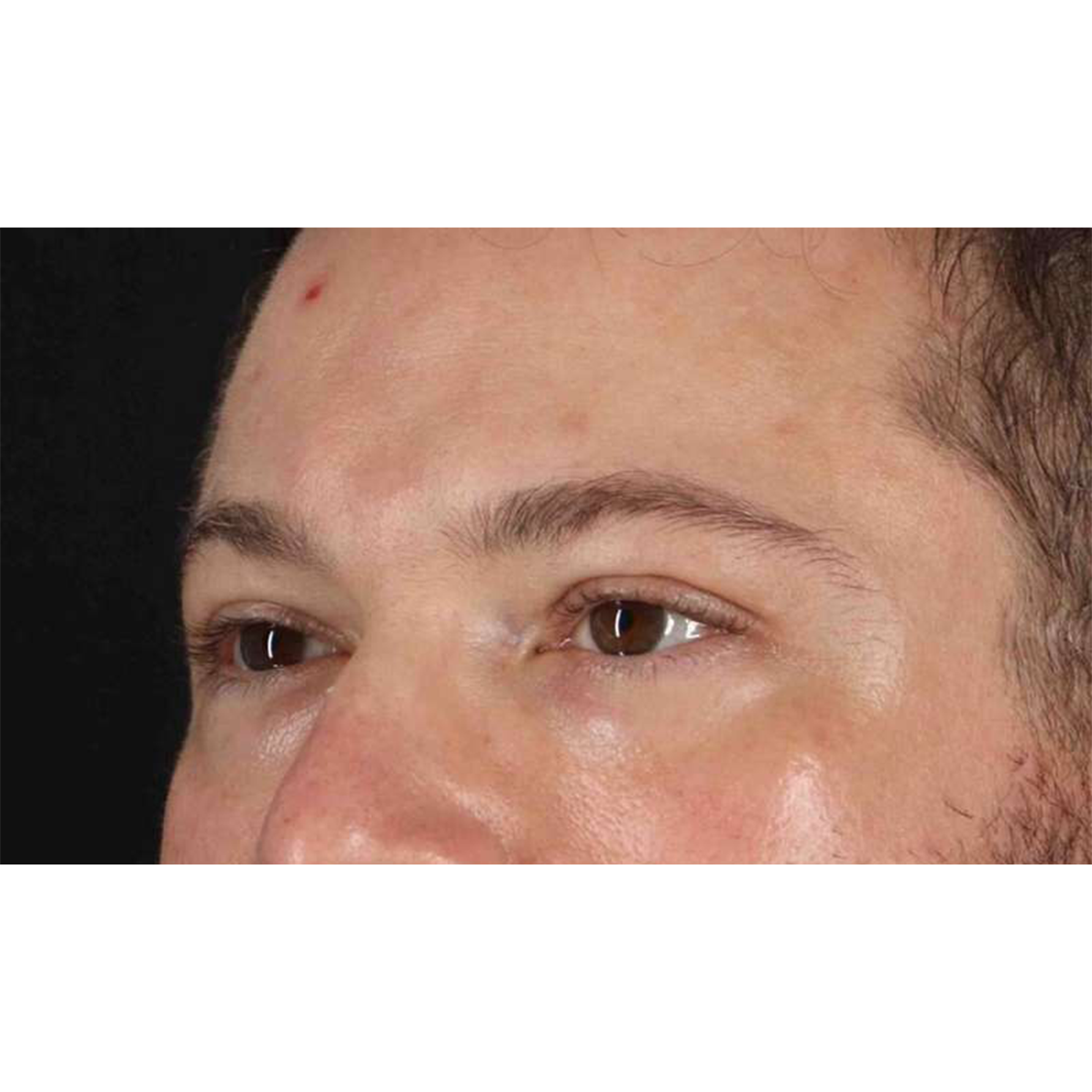 Blepharoplasty (Eyelid Surgery) Before & After Patient #10628