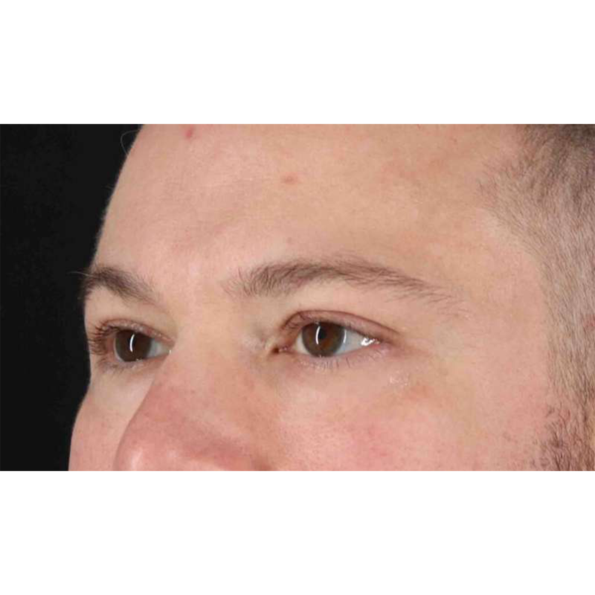 Blepharoplasty (Eyelid Surgery) Before & After Patient #10628