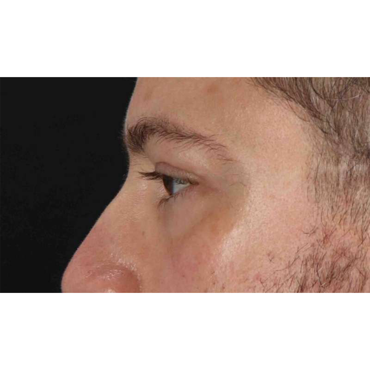 Blepharoplasty (Eyelid Surgery) Before & After Patient #10628
