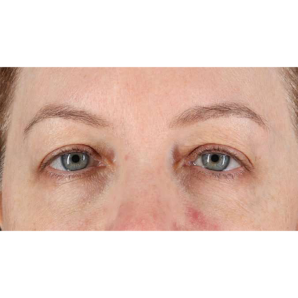 Blepharoplasty (Eyelid Surgery) Before & After Patient #10617