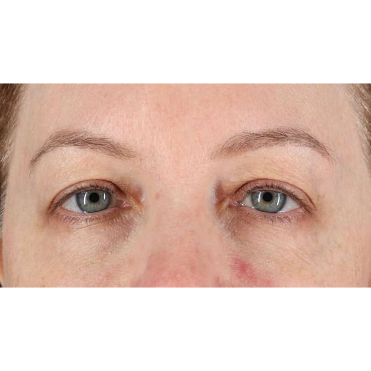 Blepharoplasty (Eyelid Surgery) Before & After Patient #10617
