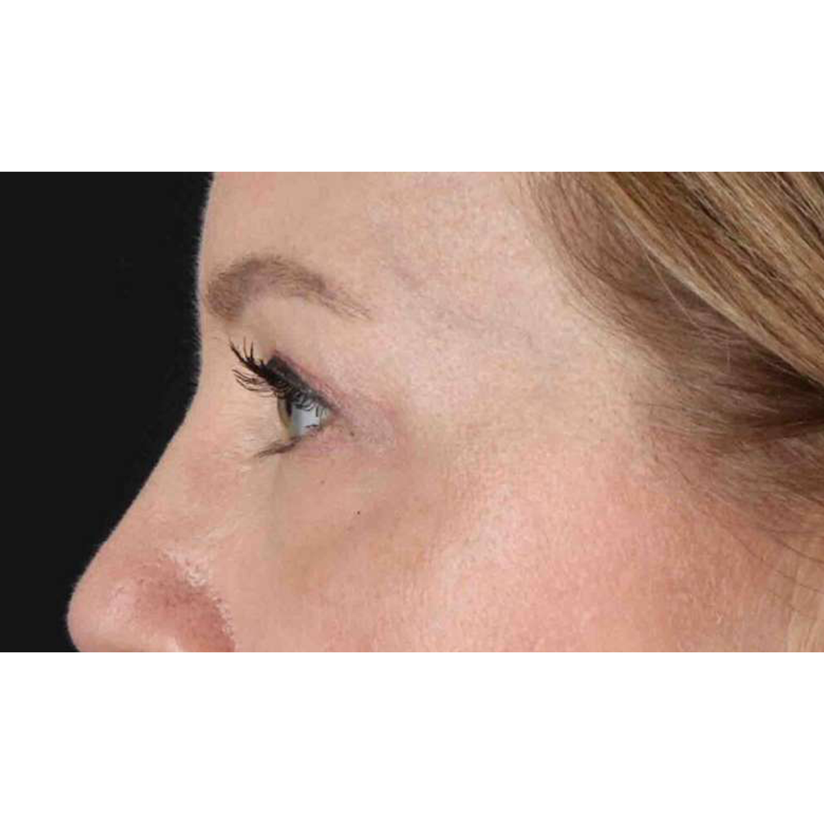 Blepharoplasty (Eyelid Surgery) Before & After Patient #10617