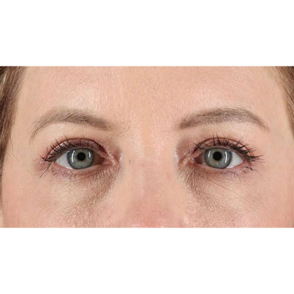 Blepharoplasty (Eyelid Surgery) Before & After Patient #10617