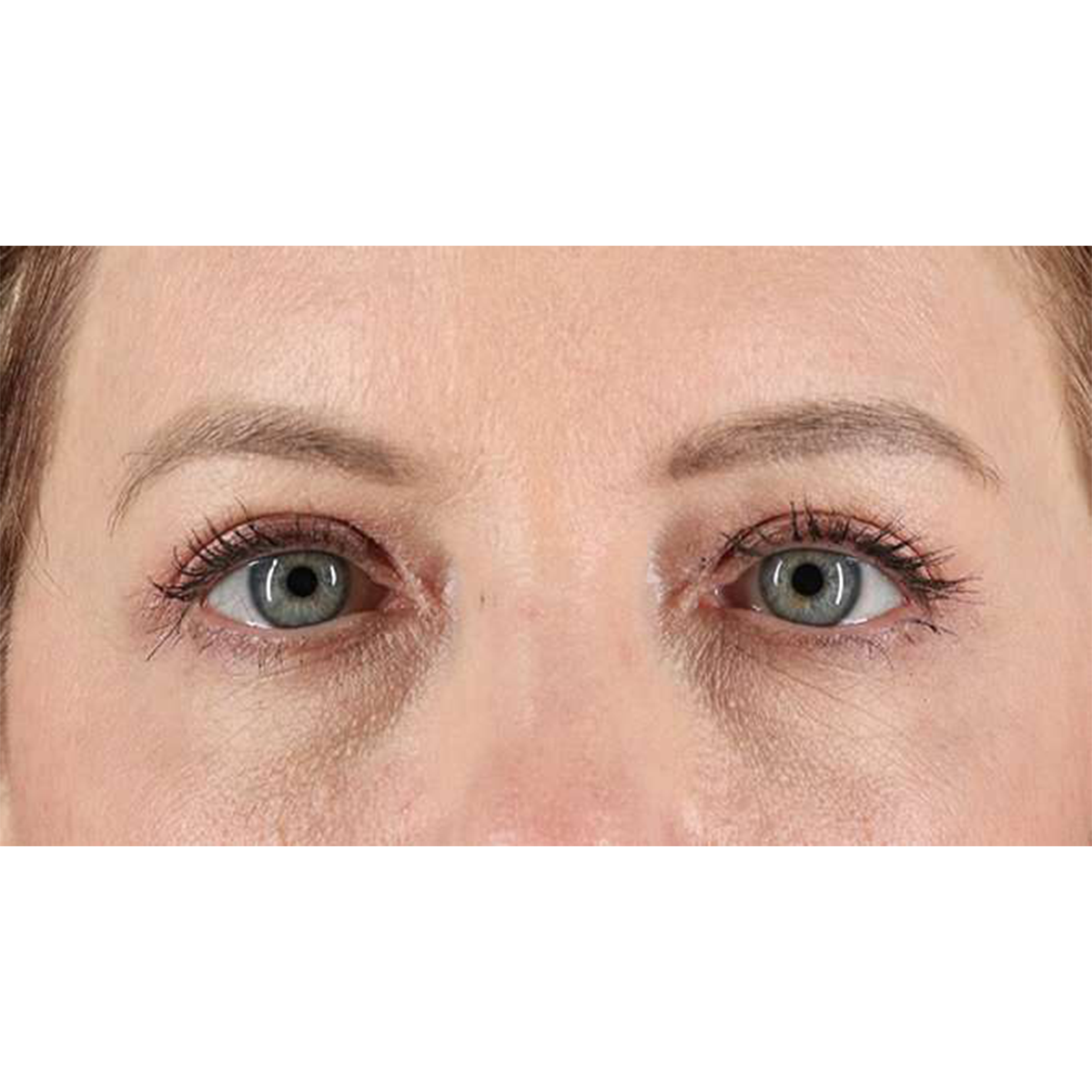 Blepharoplasty (Eyelid Surgery) Before & After Patient #10617