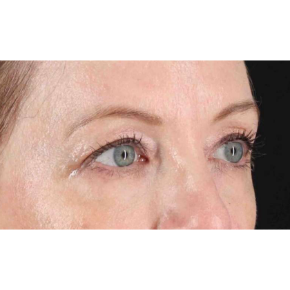Blepharoplasty (Eyelid Surgery) Before & After Patient #10617