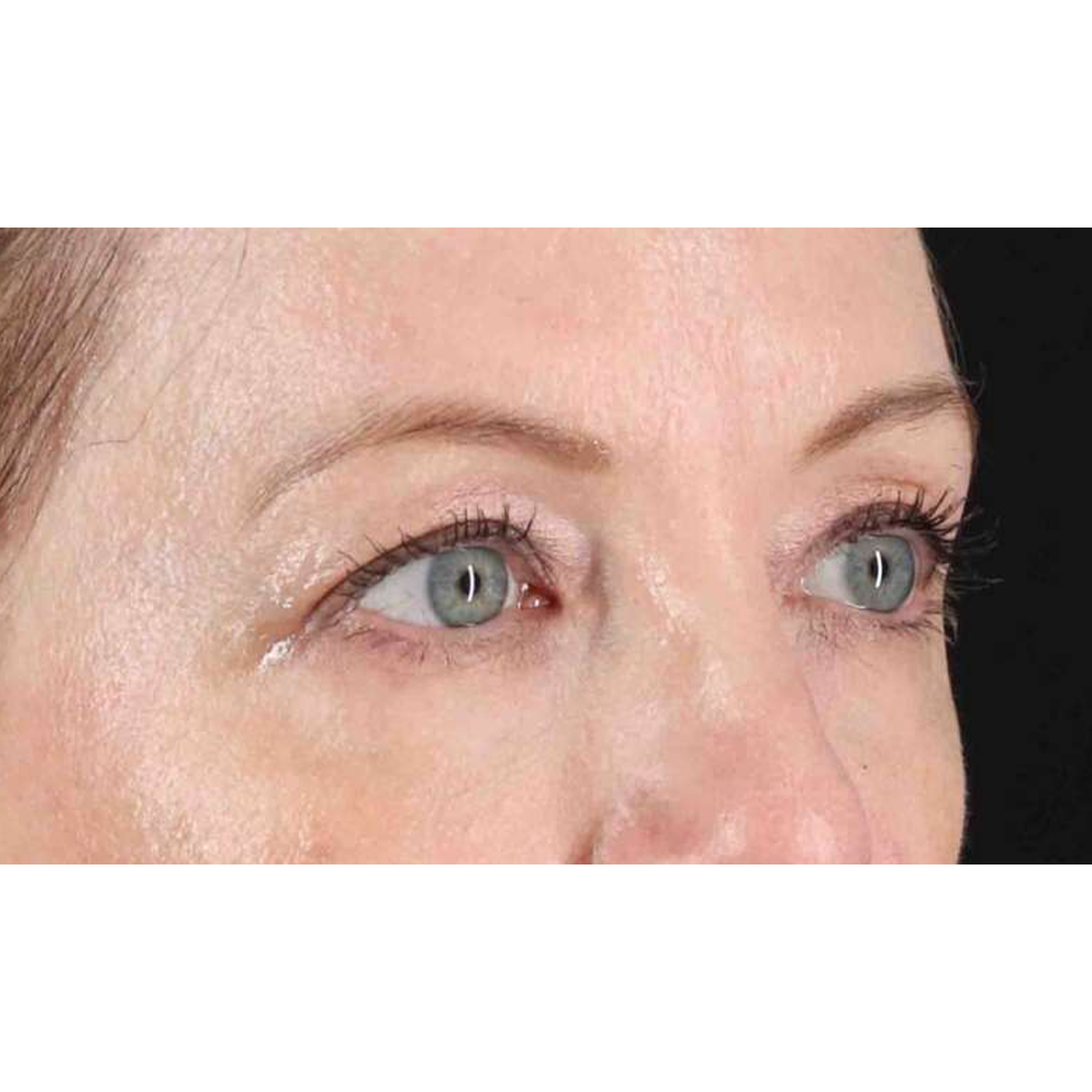 Blepharoplasty (Eyelid Surgery) Before & After Patient #10617