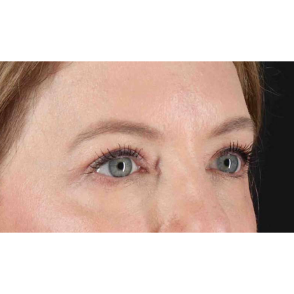 Blepharoplasty (Eyelid Surgery) Before & After Patient #10617