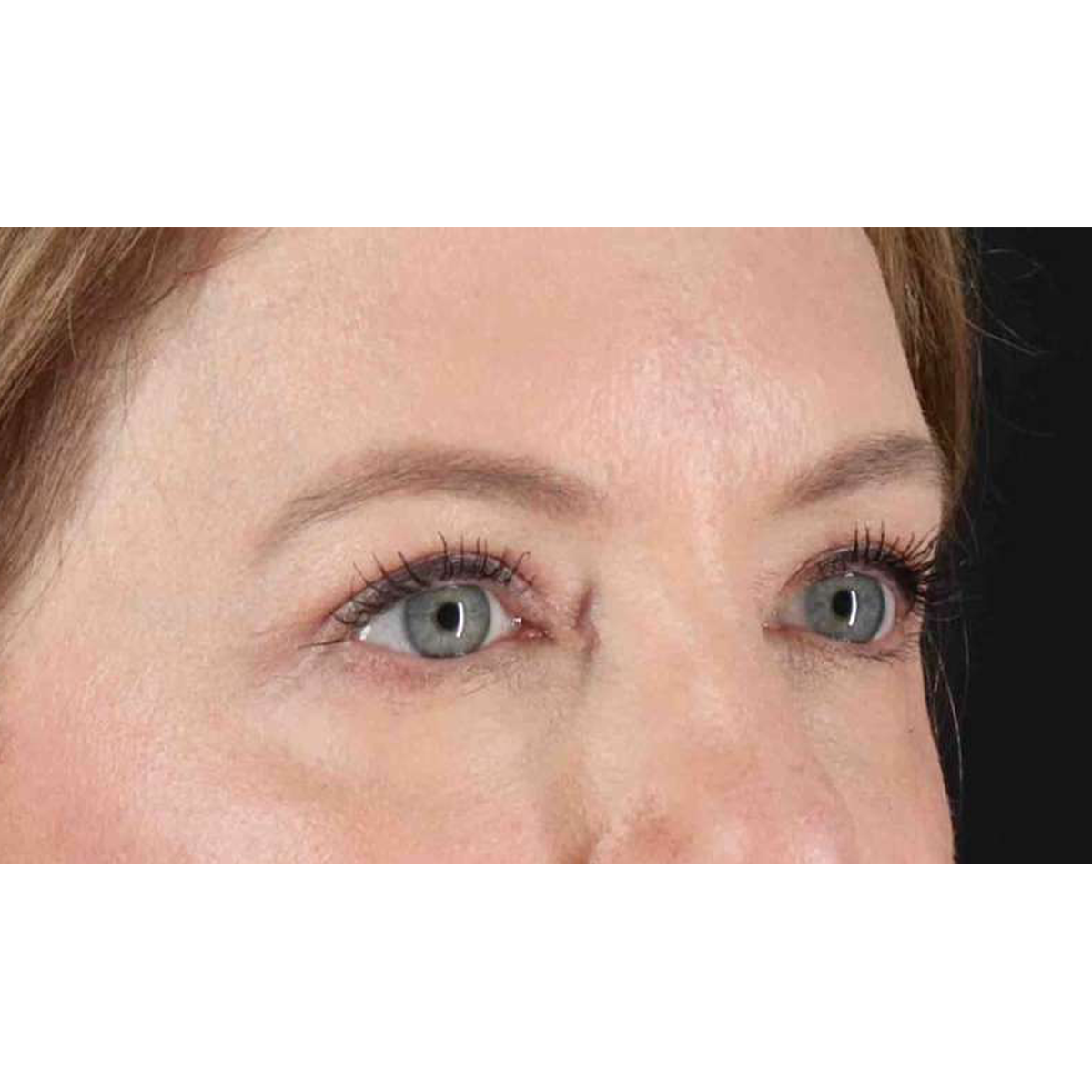 Blepharoplasty (Eyelid Surgery) Before & After Patient #10617