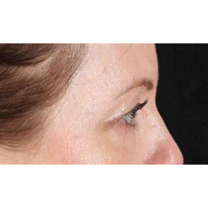 Blepharoplasty (Eyelid Surgery) Before & After Patient #10617