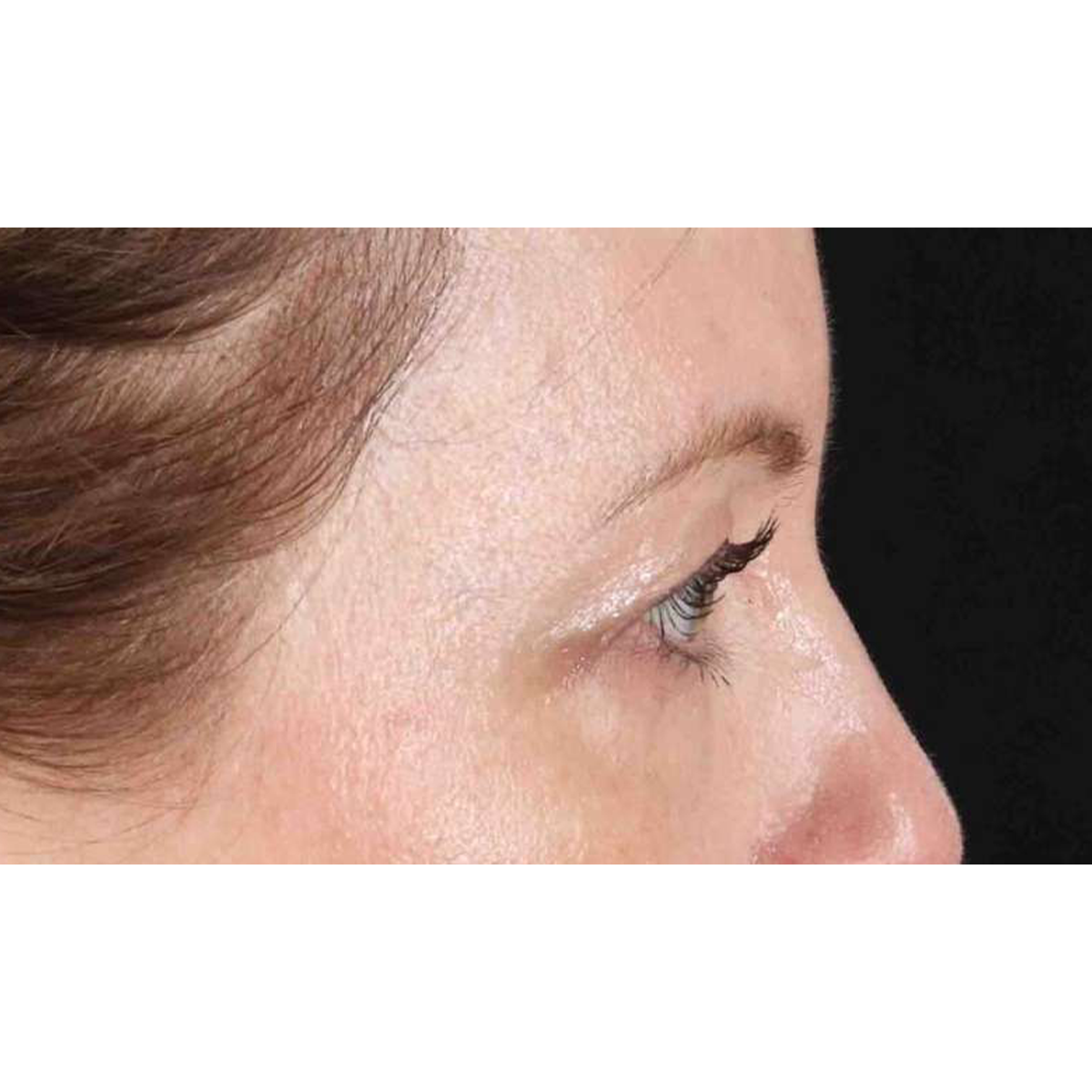 Blepharoplasty (Eyelid Surgery) Before & After Patient #10617