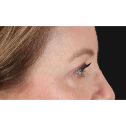 Blepharoplasty (Eyelid Surgery) Before & After Patient #10617