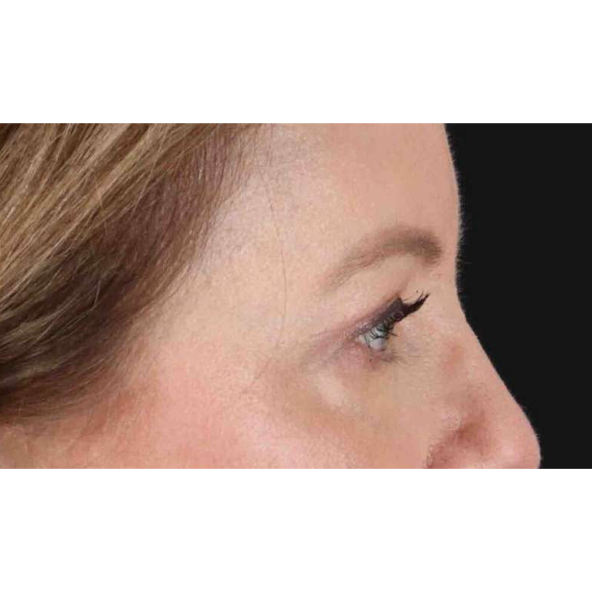 Blepharoplasty (Eyelid Surgery) Before & After Patient #10617