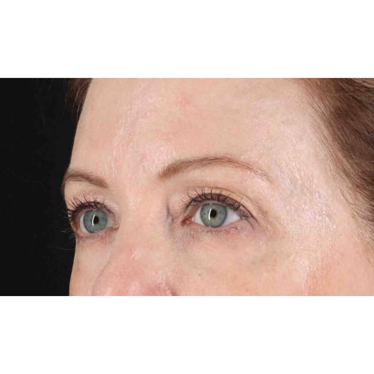 Blepharoplasty (Eyelid Surgery) Before & After Patient #10617