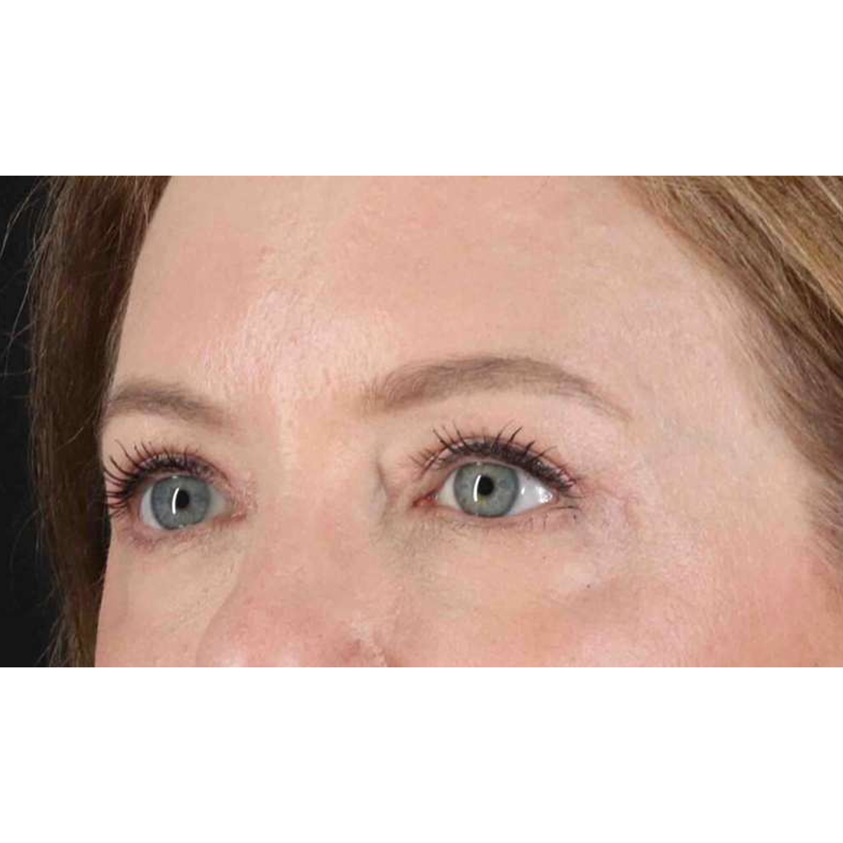 Blepharoplasty (Eyelid Surgery) Before & After Patient #10617