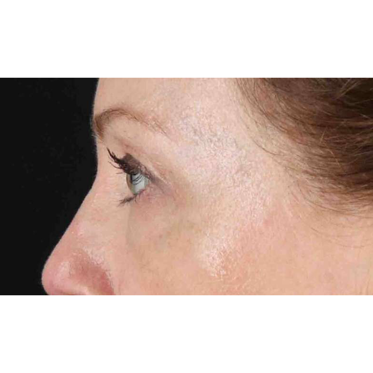 Blepharoplasty (Eyelid Surgery) Before & After Patient #10617