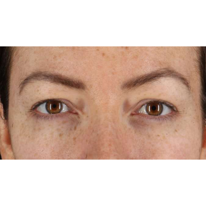 Blepharoplasty (Eyelid Surgery) Before & After Patient #10771