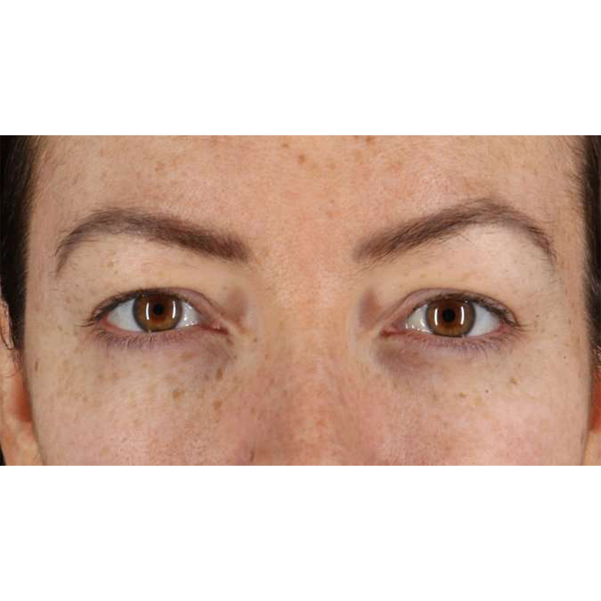 Blepharoplasty (Eyelid Surgery) Before & After Patient #10771