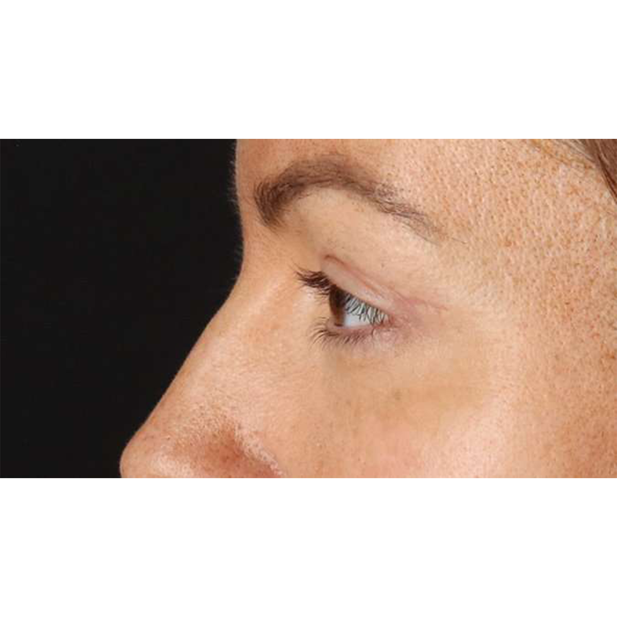 Blepharoplasty (Eyelid Surgery) Before & After Patient #10771