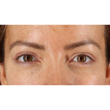Blepharoplasty (Eyelid Surgery) Before & After Patient #10771
