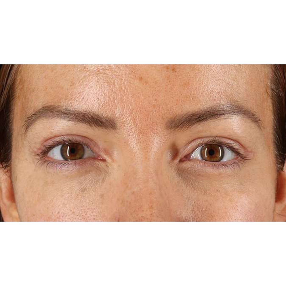 Blepharoplasty (Eyelid Surgery) Before & After Patient #10771